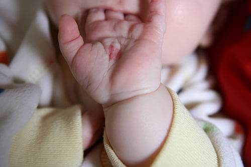 Birthmark Removal Cost